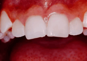 A closeup photo of a persons teeth, dental photo
