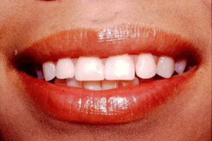 A closeup photo of a persons teeth, dental photo
