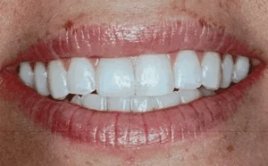 A closeup photo of a persons teeth, dental photo