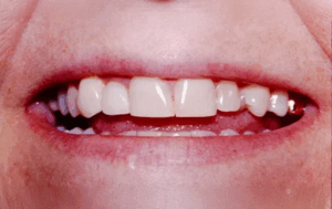 A closeup photo of a persons teeth, dental photo