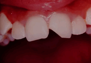 A closeup photo of a persons teeth, dental photo