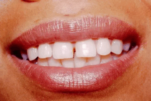 A closeup photo of a persons teeth, dental photo