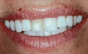 A closeup photo of a persons teeth, dental photo