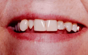 A closeup photo of a persons teeth, dental photo