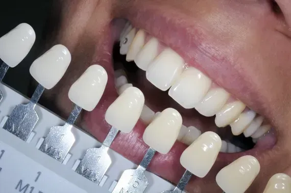A photo of a persons teeth with molds of cosmetic teeth