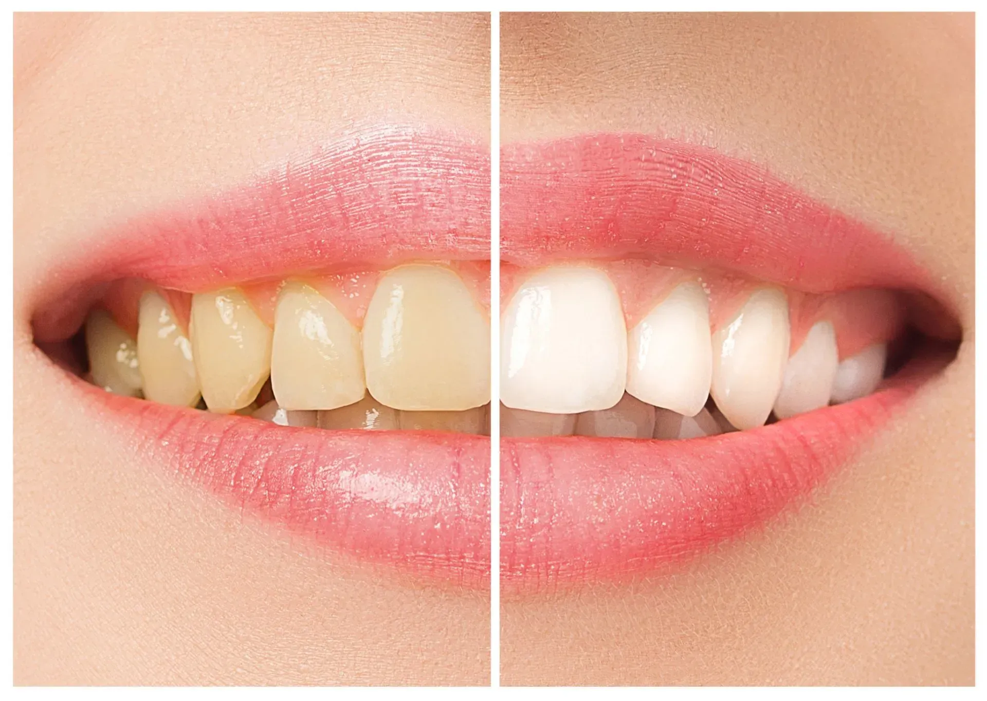 A before an after picture of a persons smile with whiter teeth in the after